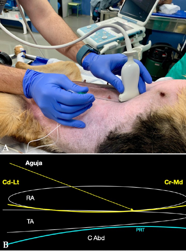 <p>(<strong>A</strong>) Posición del transductor y la aguja para el abordaje en plano del plano del transverso abdominal subcostal. (<strong>B</strong>) Imagen esquemática de las estructuras anatómicas y la aguja. Músculo recto del abdomen (RA), músculo transverso abdominal (TA), plano del transverso abdominal (TAP), peritoneo (PRT), cavidad abdominal (C Abd). Cr: Craneal, Cd: Caudal, Lt: Lateral, Md: Medial.</p>
