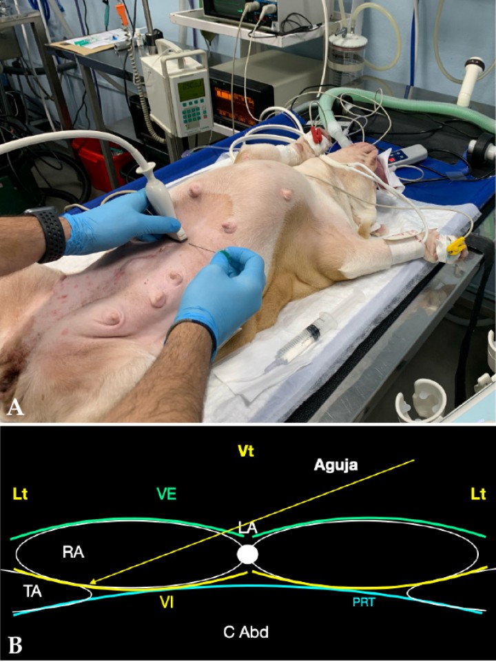 <p>(<strong>A</strong>) Posición del transductor y la aguja para el abordaje en plano de la vaina del recto del abdomen. (<strong>B</strong>) Imagen esquemática de las estructuras anatómicas y la aguja. Músculo recto del abdomen (RA), músculo transverso abdominal (TA), vaina externa (VE), vaina interna (VI), línea alba (LA), peritoneo (PRT), cavidad abdominal (C Abd). Lt: Lateral, Vt: Ventral.</p>