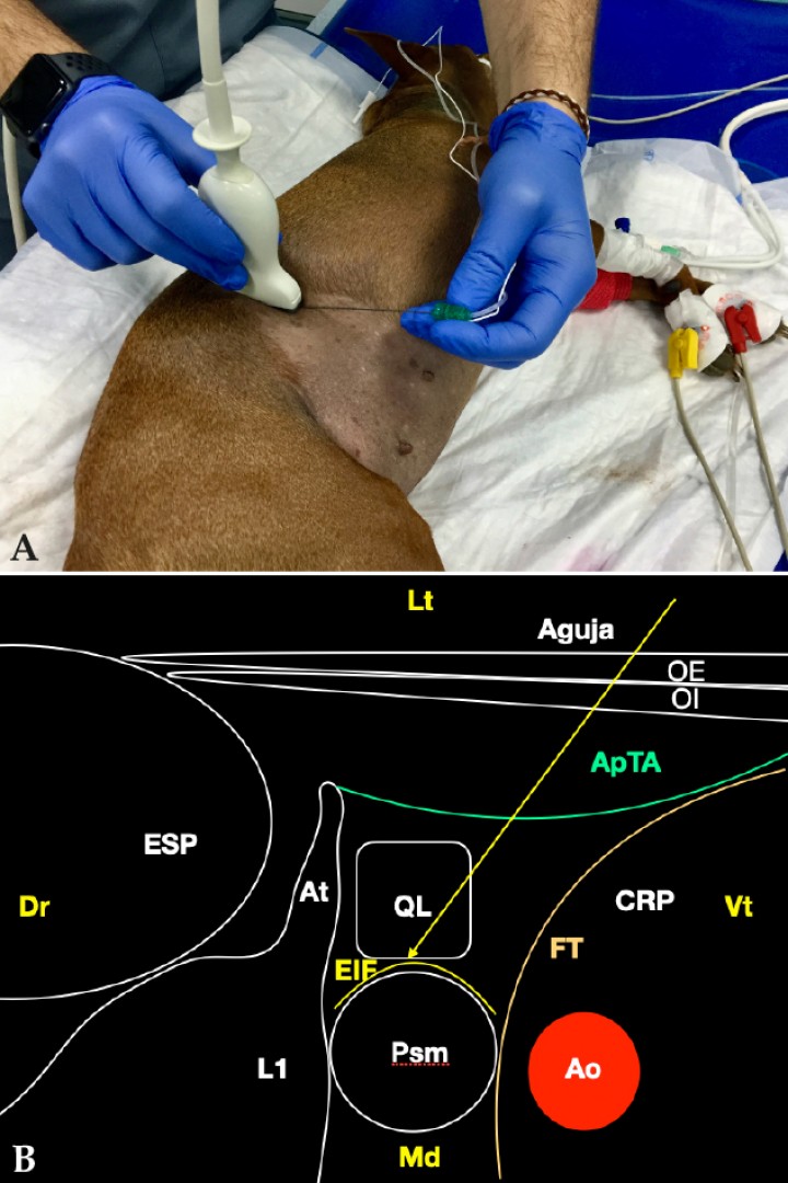 <p>(<strong>A</strong>) Posición del transductor y la aguja para el abordaje en plano del músculo cuadrado lumbar. (<strong>B</strong>) Imagen esquemática de las estructuras anatómicas y la aguja. Músculo cuadrado lumbar (QL), músculo psoas menor (Psm), espacio interfascial (EIF), aponeurosis de inserción del músculo transverso abdominal (ApTA), fascia transversalis (FT), cavidad retroperitoneal (CRP), arteria aorta (Ao), grupo del erector espinal (ESP), vértebra L1 (L1), apófisis transversa (At). Dr: Dorsal, Vt: Ventral, Lt: Lateral, Md: Medial.</p>