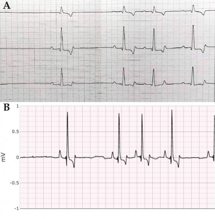 <p>Trazados electrocardiográficos del mismo perro obtenidos mediante electrocardiógrafo de referencia en papel (<strong>A</strong>; 10 mm/mV, 50 mm/s) y de su correspondiente registro Dinbeat (<strong>B</strong>; 10 mm/mV, 25 mm/s). La morfología del trazado Dinbeat es análoga a la derivación II del registro en papel (centro). En ambos casos se muestran ejemplos de registros de buena calidad (calidad 5) y se evidencia la presencia de arritmia sinusal.</p>