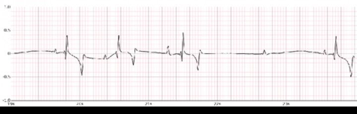 <p>Trazado electrocardiográfico Dinbeat mostrando un bloqueo atrioventricular de 2º grado (onda P no seguida de QRS). 10 mm/mV, 25 mm/s.</p>