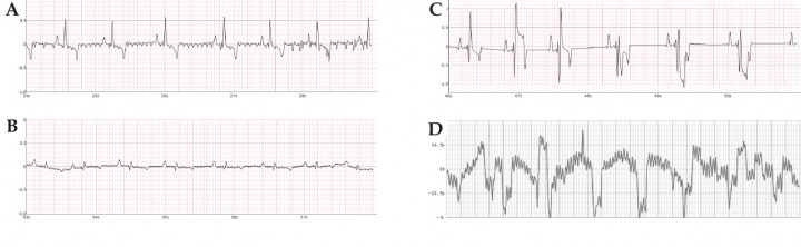 <p>Registros electrocardiográficos Dinbeat mostrando diversos grados de alteraciones que determinan su clasificación como calidad 4 (<strong>A</strong>), 3 (<strong>B</strong>), 2 (C) y 1 (D). 10 mm/mV, 25 mm/s.</p>