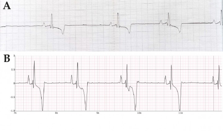 <p>Registros electrocardiográficos en papel del mismo perro. (<strong>A</strong>) DII, 10 mm/mv, 50 mm/s. (<strong>B</strong>) Dinbeat, 10 mm/mV, 25 mm/s. Nótese como la onda T aparece exageradamente negativa en el registro Dinbeat.</p>
