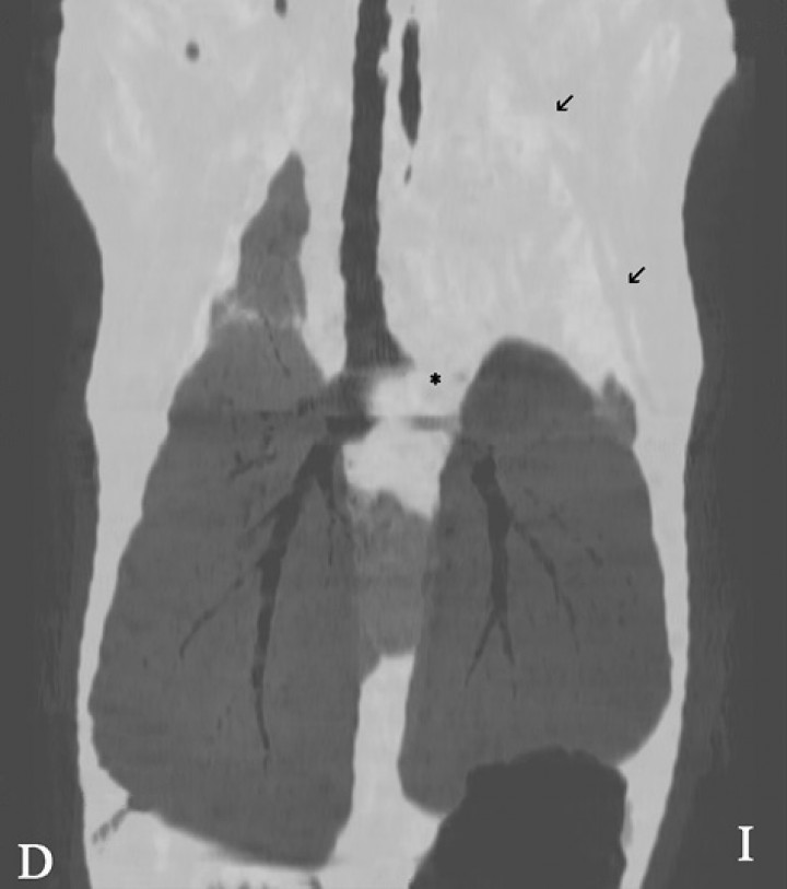 <p>Imagen de tomografía computarizada (TC) en plano dorsal y reconstrucción en MinP. Se evidencia una interrupción del bronquio lobar craneal izquierdo (asterisco), visualizándose dicho lóbulo pulmonar (flechas negras) consolidado.</p>