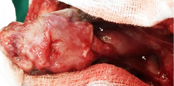 <p>Imagen quirúrgica del lóbulo pulmonar craneal izquierdo, una vez liberado de las adherencias al lóbulo pulmonar adyacente y a la pleura, en la que se observa la zona de la torsión en el hilio bronquial (flechas blancas).</p>