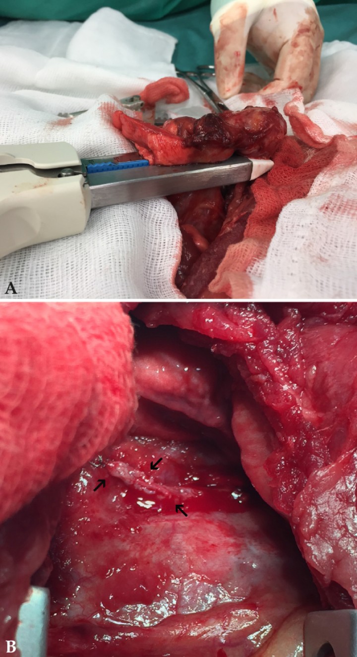 <p>Imagen quirúrgica durante el empleo de la grapadora quirúrgica para la realización de la lobectomía pulmonar (<strong>A</strong>), y detalle del sellado con doble línea de micrograpas (flechas negras) una vez finalizado el procedimiento (<strong>B</strong>).</p>