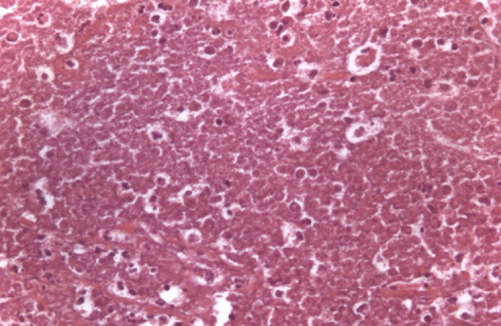 <p>Imagen histopatológica de una porción del lóbulo pulmonar torsionado. Se visualiza un detalle de la zona central de uno de los amplios secuestros observados en el parénquima pulmonar en la que puede evidenciarse una extensa necrosis. 40x, hematoxilina-eosina.</p>