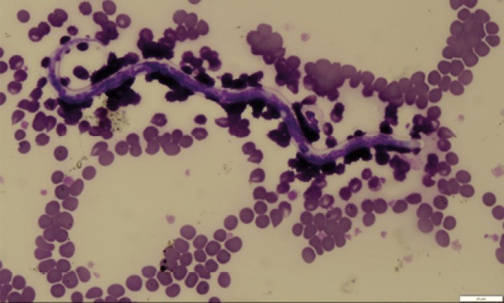 <p><strong>Filariosis</strong>. Las microfilarias son larvas de nemátodos que parasitan perros y, raramente, gatos. Pueden verse con el objetivo de 10x, sobre todo en las puntas del frotis. Son estructuras serpentiformes, de unas 300 µm, cuyos núcleos celulares se tiñen de color azulado. La clasificación de la especie por su morfología en frotis es difícil, ya que el extremo cefálico y la cola se tiñen poco y el tipo de fijación puede alterar su tamaño. Para la identificación de la especie se recomiendan otras técnicas (PCR, tinción de fosfatasa ácida, etc.). En esta imagen, la forma redondeada de la cabeza y la cola con final recto serían compatibles con <em>Dirofilaria immitis</em>.</p>