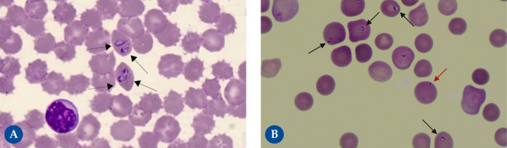 <p><strong>Babesiosis</strong>. Las babesias son piroplasmas que parasitan los eritrocitos provocando diferentes grados de anemia, trombocitopenia y fiebre. La sangre capilar puede presentar mayor carga parasitaria que la sangre venosa. En nuestra zona geográfica encontramos babesias grandes (<em>B. canis</em> y <em>B. vogelis</em>) que miden entre 2,5 y 5 μm. Tienen formas ovaladas (a veces en forma de lágrima), aunque su aspecto puede variar dependiendo de la conservación de la sangre. En la Fig. 3<strong>A</strong> se observan cuatro merozoitos intraeritrocitarios (flechas negras) en parejas de <em>B. canis</em>, con un citoplasma azul claro, núcleo azul oscuro y una pared celular evidente. Las babesias de tamaño pequeño descritas en España son<em> B. gibosni</em> y otra especie que no está completamente identificada, similar a <em>B. microti</em> (denominada <em>B. microti</em>-like). Su tamaño (1 a 2,5 μm) hace que su detección requiera una evaluación más detallada del frotis sanguíneo. Tienen forma de anillo con una membrana delgada, citoplasma claro y núcleo pequeño azulado/violáceo. En la Fig. 3<strong>B</strong> se observan varios merozoitos de <em>B. microti</em>-like (flechas negras), en un paciente con anemia muy regenerativa y eritrocitos con cuerpos de Howell-Jolly (flecha roja).</p>