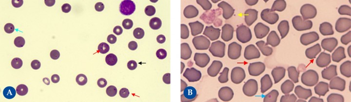 <p><strong>Micoplasmas hemotrópicos</strong>. Hay diferentes especies de micoplasmas hemáticos que afectan a gatos: <em>Mycoplasma haemofelis</em> (Fig. 4<strong>A</strong>), <em>Candidatus M. haemominutum</em> y <em>Candidatus M. turicensis</em>; así como a perros: <em>M. haemocanis</em> (Fig. 4<strong>B</strong>) y <em>Candidatus M. haematoparvum</em>. El cuadro clínico (desde detección incidental a anemia hemolítica) depende de la especie y de posibles patologías concomitantes. Son bacterias muy pequeñas, de 0,1 a 1 μm (<em>M. haemofelis</em>, la más patogénica en gatos, es la de mayor tamaño), que se sitúan sobre la superficie de los eritrocitos en forma de cocos, bastoncillos y raramente en anillo (flecha negra). En ocasiones también pueden observarse libres sobre el fondo de la preparación (flecha amarilla). No deben confundirse con cuerpos de Howell-Jolly (flecha azul), habitualmente de mayor tamaño, ni con restos de tinción u otros detritus. Se identifican más fácilmente (flechas rojas) cuando se presentan en cadenas o la disposición epicelular es más evidente. Se detectan mejor en muestras de sangre capilar y en frotis frescos. Ante poca cantidad de microorganismos es recomendable realizar pruebas de PCR que, además, permiten determinar la especie.</p>