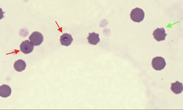 <p><strong>Cytauxzoonosis</strong>. En Europa <em>Cytauxzoon felis</em> puede encontrarse en gatos enfermos (en el curso tardío de la enfermedad) o portadores sanos. Los microorganismos (flechas rojas) son intraeritrocitarios, miden de 1 a 2 µm, tienen forma de anillo de sello, con un núcleo azul/violáceo excéntrico y un citoplasma pálido. Ocasionalmente, pueden tener un núcleo bipolar. Son parecidos a otros piroplasmas de tamaño pequeño y no deben confundirse con micoplasmas en forma de anillo (que suelen estar en las zonas más periféricas de los eritrocitos) ni con otras estructuras como cuerpos de Heinz (flecha verde).</p>