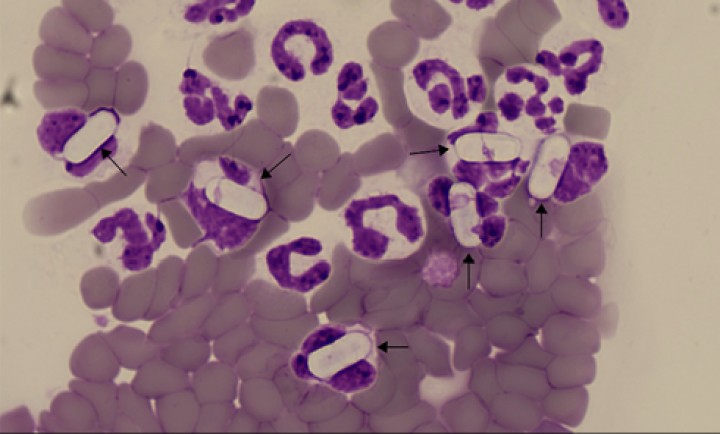 <p><strong>Hepatozoonosis</strong>. En Europa esta enfermedad está causada por <em>Hepatozoon canis</em>, un protozoo que suele causar síntomas leves e inespecíficos en perros, habitualmente en el momento de liberación de los gamontes en la sangre periférica. Los gamontes (flechas negras) parasitan el citoplasma de los neutrófilos, detectándose una proporción variada de células afectadas (en general entre el 1 y el 5 %) que suelen disponerse en la periferia del frotis. Se pueden observar a 40x, tienen forma de cápsula clara o muy levemente basofílica, de unas 11 x 4 μm, con un núcleo que normalmente no se tiñe. En sangre vieja puede verse únicamente la cápsula vacía.</p>