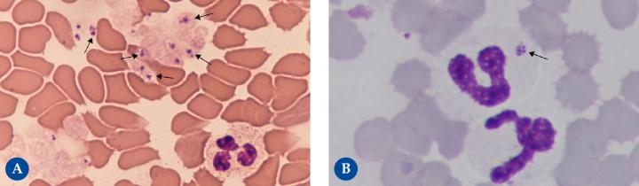 <p><strong>Anaplasmosis</strong>. <em>A. platys</em> es el causante de la trombocitopenia cíclica infecciosa canina y <em>A. phagocytophilum</em> de la ehrlichiosis granulocítica en perros y gatos. Ambas son bacterias intracelulares obligadas de tamaño muy pequeño que se reproducen en fagosomas dentro de las células hemáticas, formando colonias bacterianas denominadas mórulas. Las mórulas de <em>A. platys</em> (flechas de la Fig. 7<strong>A</strong>) se observan dentro de las plaquetas. Su eliminación en sangre es cíclica, lo que, junto con la presencia de un número bajo de plaquetas, puede dificultar su detección. Las inclusiones de <em>A. platys</em> son de color azul oscuro y deben distinguirse de los gránulos de las plaquetas que son de color magenta y más irregulares. <em>A. phagocytophilum</em> (Fig. 7<strong>B</strong>) es una bacteria cocobacilar, de 0,3 a 1,3 μm de diámetro y hasta 2 μm de longitud, que infecta más comúnmente a los neutrófilos. Las mórulas (flecha negra) aparecen como inclusiones redondas, a menudo punteadas (compuestas por varias subunidades bacterianas) y se tiñen más oscuro que el núcleo de la célula infectada.</p>