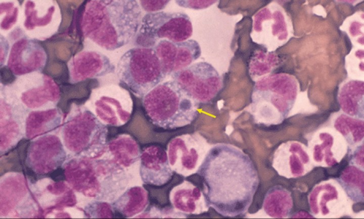 <p><strong>Ehrlichiosis</strong>. <em>Ehrlichia canis</em> es también una bacteria intracelular obligada que afecta a perros y raramente a gatos. Tanto la fase aguda de la enfermedad como la crónica pueden presentarse con alteraciones hematológicas. De forma muy ocasional en sangre circulante pueden observarse mórulas (flecha amarilla) en el citoplasma de linfocitos y/o monocitos. La cantidad de leucocitos infectados suele ser muy baja, por lo que los métodos de leucoconcentración (como en esta figura) mejoran su detección. Aun así, las técnicas de PCR son las recomendadas para obtener una mejor sensibilidad.</p>