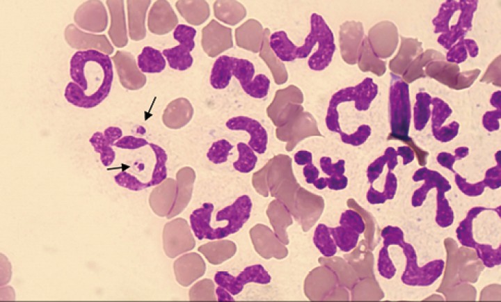 <p><strong>Leishmaniosis</strong>. Aunque es poco habitual, algunos perros con leishmaniosis pueden presentar amastigotes en sangre periférica, fagocitados por los neutrófilos o raramente por los monocitos. Las flechas negras señalan dos amastigotes intracelulares de <em>Leishmania infantum</em>. Los amastigotes son de ovalados a redondeados, miden 1-2 x 2-4 μm, presentan un citoplasma de color claro envuelto por una membrana, con un núcleo ovalado violáceo oscuro. La visualización del quinetoplasto, normalmente perpendicular al núcleo y de color similar, facilita la identificación del parásito. Se desconoce la significación clínica de su observación en sangre.</p>