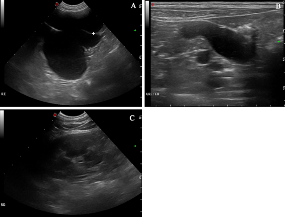 Imágenes ecográficas al año de la primera presentación. (<b>A</b>) Hidronefrosis del riñón izquierdo: se observa una marcada dilatación de la pelvis renal y divertículos del riñón izquierdo por líquido anecogénico con una mínima remanencia de la corteza renal. (<b>B</b>) Severo hidrouréter izquierdo con contenido líquido anecogénico. (<b>C</b>) Riñón derecho de aspecto normal.