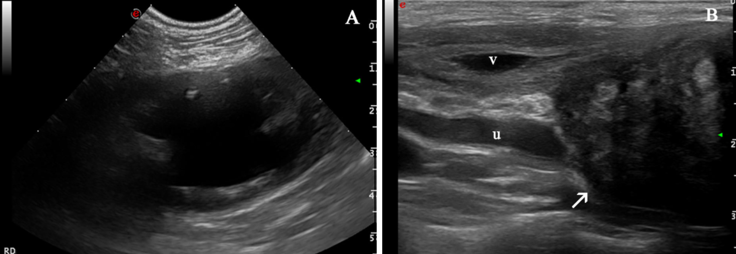 Imágenes ecográficas a los tres meses de la segunda presentación. (<b>A</b>) Hidronefrosis del riñón derecho: se observa una marcada dilatación de la pelvis renal y divertículos del riñón derecho por líquido anecogénico con una mínima remanencia de la corteza renal. (<b>B</b>) El uréter derecho (u) dorsal a la vejiga de la orina (v) e involucrado con la masa (flecha blanca) se visualiza dilatado (hidrouréter).