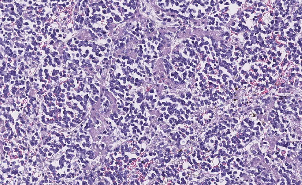 Sinusoides hepáticos distendidos por la presencia circulante de la población neoplásica, con degeneración y pérdida de trabéculas hepatocitarias (x200, tinción H/E).