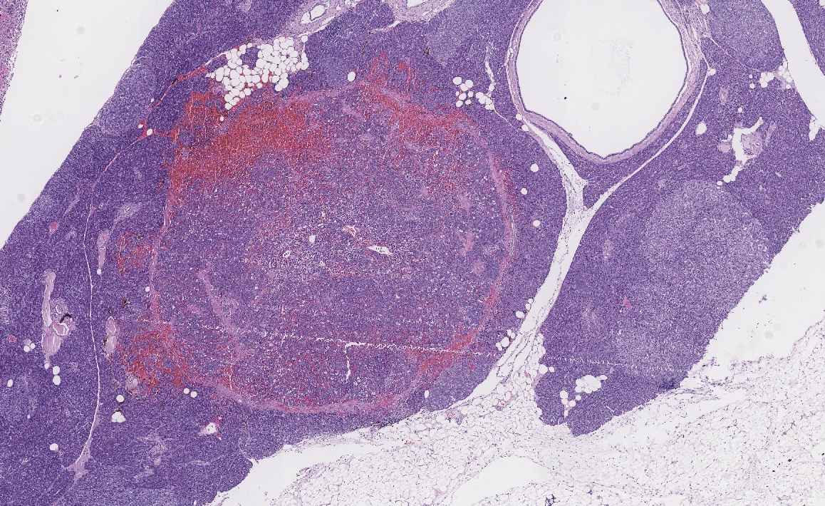 Parénquima pancreático infiltrado y parcialmente reemplazado por la neoplasia (x100, tinción H/E).