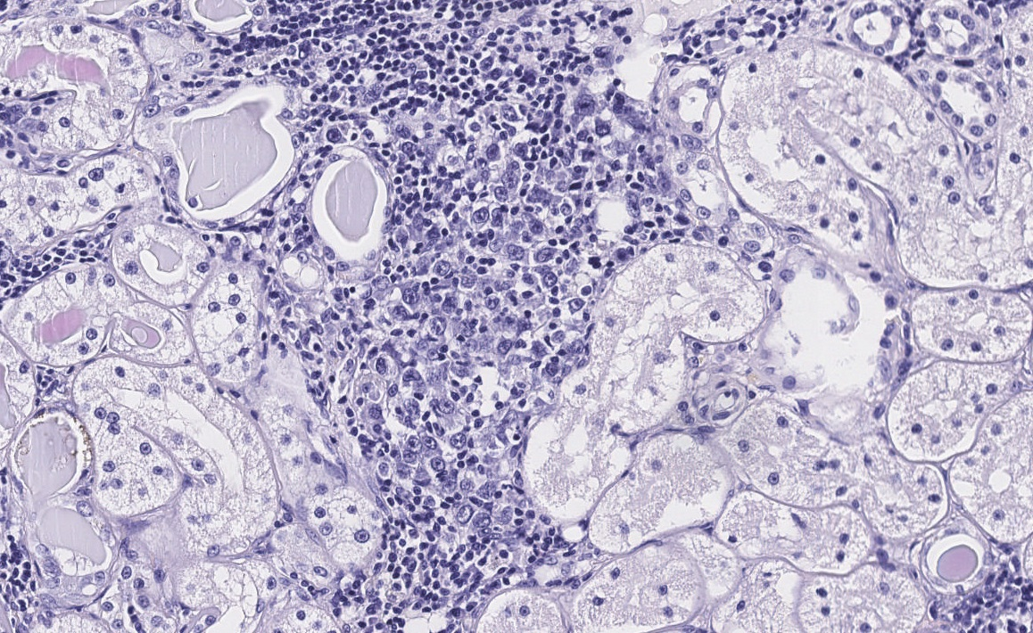 Infiltración intersticial renal por la misma población neoplásica (x200, tinción H/E).