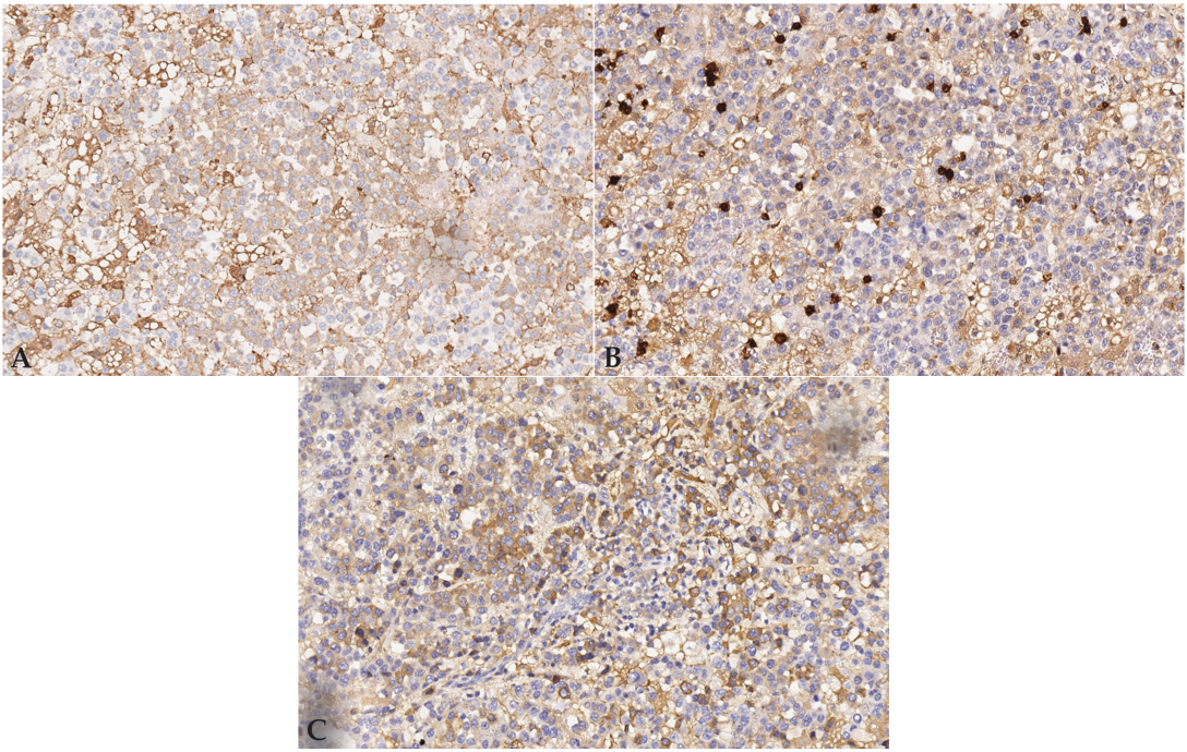 Estudio inmunohistoquímico. (<b>A</b>) Positividad débil de la célula neoplásica para marcador CD79 (x200, tinción inmunohistoquímica CD79). (<b>B</b>) Las células neoplásicas son negativas para CD3. Se observan escasos linfocitos CD3 positivos (x200, tinción inmunohistoquímica CD3). (<b>C</b>) Positividad citoplasmática de la célula neoplásica para marcador CD138 (x200, tinción inmunohistoquímica CD138).