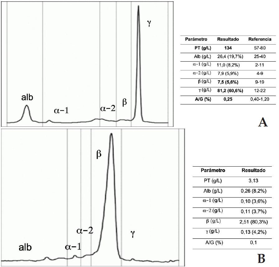 Electroforesis de proteínas en suero y orina. (<b>A</b>) Electroforesis capilar de proteínas séricas en la que se observa un marcado aumento en la fracción de las gammaglobulinas. (<b>B</b>) Electroforesis de proteínas urinarias sobre gel de agarosa en el que se demuestra un pico marcado en la fracción de las betaglobulinas. PT=proteínas totales; Alb= albúmina; α-1= alfa-1 globulinas; α-2= alfa-2 globulinas; β= beta globulinas; γ = gamma globulinas; A/G= ratio albúmina/globulina.