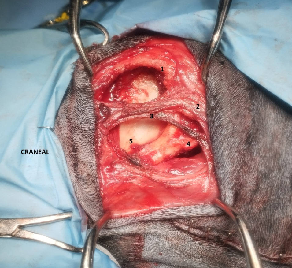 Imagen tras resección compartimental del músculo masetero izquierdo. 1: borde caudal del arco cigomático; 2: glándula parótida; 3: conducto parotídeo, ramas faciales (arterias y venas), ramas del nervio facial; 4: proceso angular mandibular; 5: fosa del masetero de la rama mandibular izquierda.