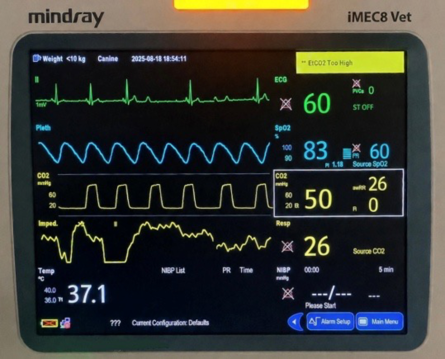 Durante la estabilización inicial, el monitor muestra hipoxemia grave (SpO₂ <90 %) e hipercapnia concomitante (EtCO₂ = 50 mmHg) a pesar de la oxigenoterapia administrada mediante cánula nasal, lo que hace imperativo la intensificación en el soporte respiratorio y valorar la intubación endotraqueal en caso de evolución desfavorable. La hipoxemia grave podría ser multifactorial: por la hipoperfusión sistémica asociada al estado de shock y alteraciones respiratorias contribuyendo al deterioro del intercambio gaseoso y la ventilación. Asimismo, se identifica un bloqueo atrioventricular de segundo grado (Mobitz I), atribuible al aumento del tono vagal secundario al íleo mecánico ocasionado por la presencia de un cuerpo extraño intestinal en este caso.[1]