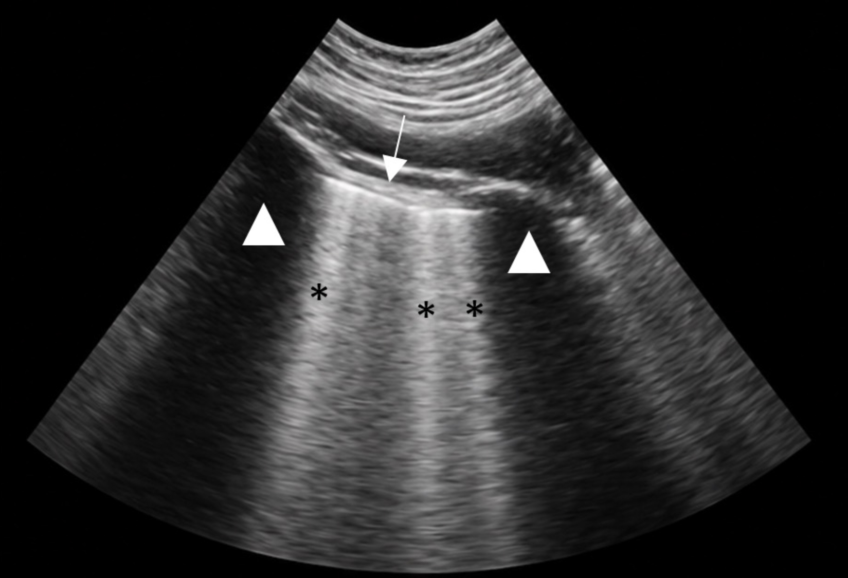 Ecografía torácica <i>point-of-care </i>(POCUS) compatible con un pulmón húmedo (<i>wet lung</i>) asociado a un patrón intersticio-alveolar. Se identifica la línea pleural (↓) delimitada lateralmente por las sombras acústicas de las costillas (∆) y la presencia de múltiples líneas B (*). Las líneas B son artefactos hiperecogénicos verticales que se originan en la línea pleura que se extienden hasta el fondo de la imagen y se desplazan sincrónicamente con el movimiento pulmonar. Este hallazgo indica un aumento del contenido extravascular pulmonar y es compatible, en este contexto clínico, con neumonía por aspiración o lesión pulmonar asociada a la respuesta inflamatoria sistémica.[5]