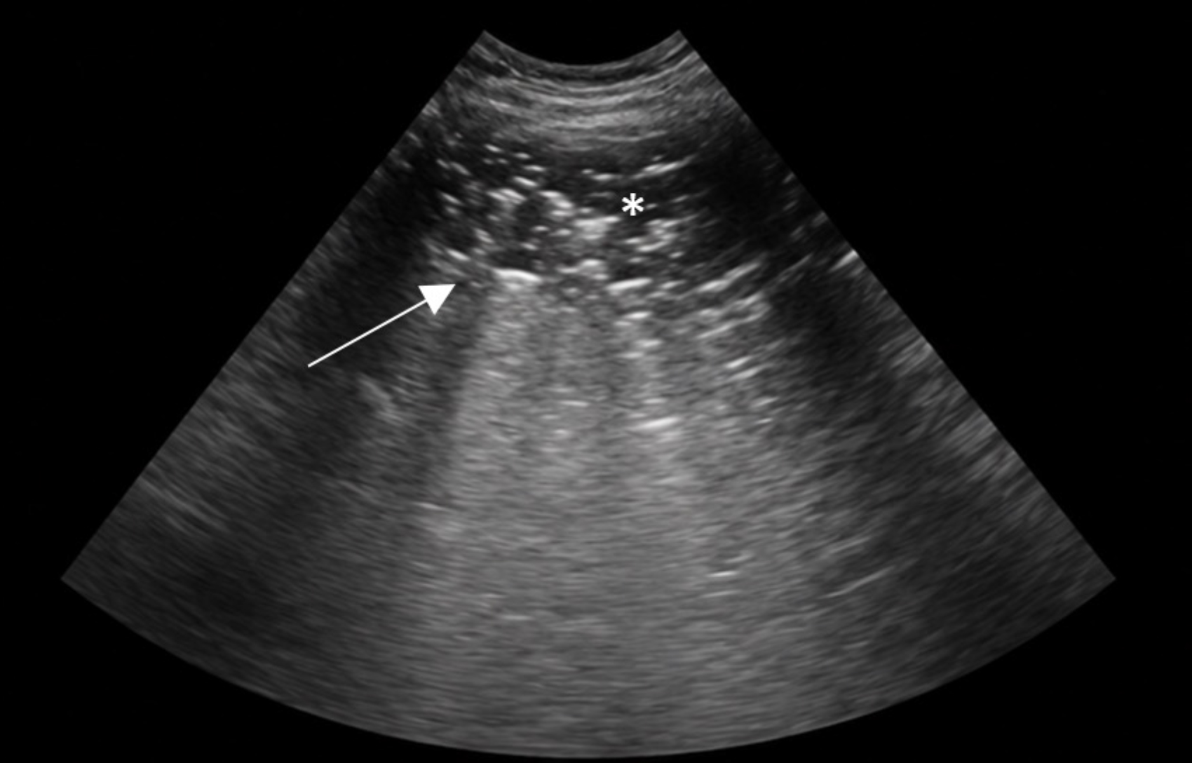 Ecografía torácica <i>point-of-care</i> (POCUS) compatible con una consolidación pulmonar (*) parcial. Se observa una región de ecotextura similar al parénquima hepático adyacente a la línea pleural, delimitada por un borde hiperecogénico irregular correspondiente al signo de desgarro (↑) (<i>shred sign</i>), que marca la transición entre el tejido pulmonar consolidado y el pulmón normalmente aireado. En pacientes con neumonía por aspiración, estas lesiones se localizan con mayor frecuencia en el lóbulo pulmonar medio derecho y en los lóbulos craneales.[5]