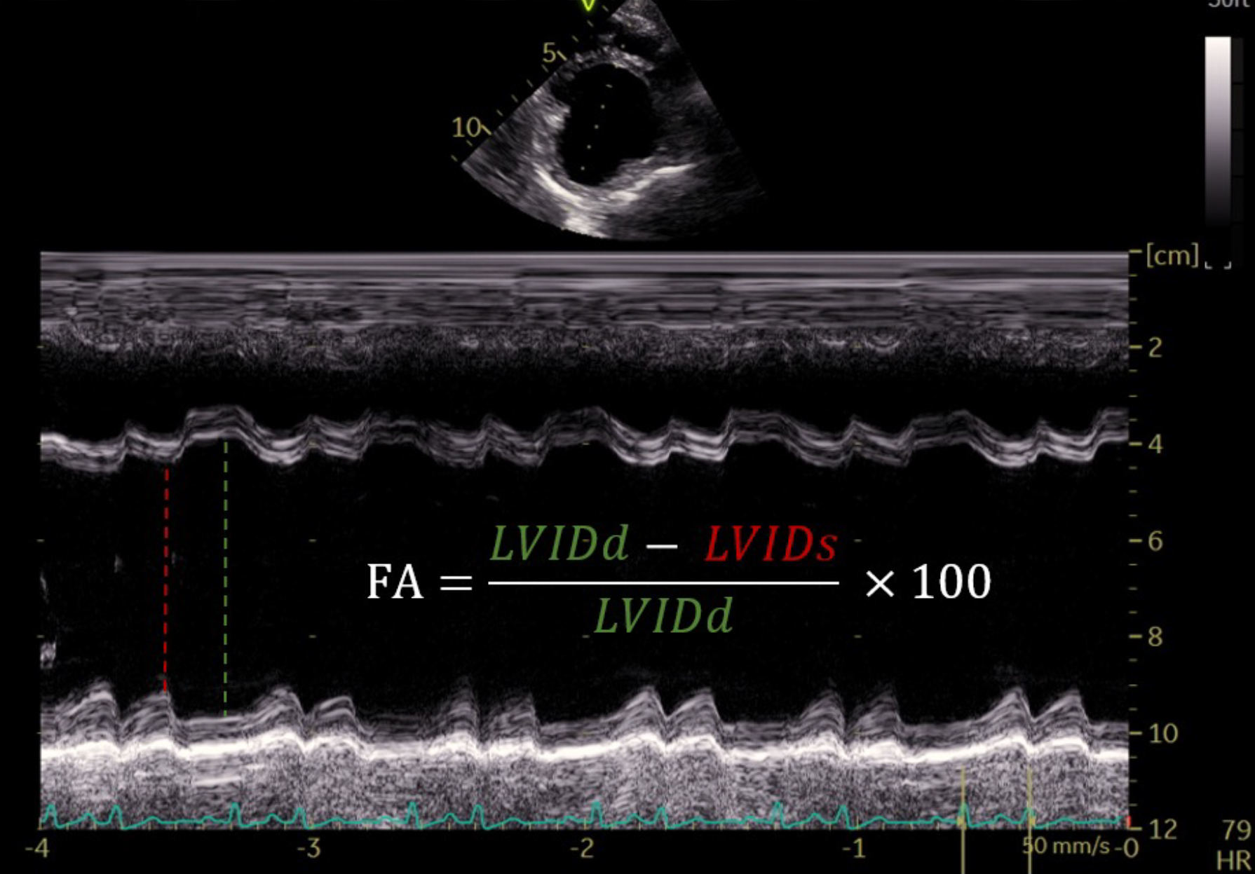 Ecografía cardíaca <i>point-of-care</i> (POCUS) en modo M obtenida desde la ventana paraesternal derecha en eje corto, a nivel de los músculos papilares. Empleada para la evaluación de la función sistólica del ventrículo izquierdo. Se observa una fracción de acortamiento disminuida (17 %), hallazgo compatible con depresión de la contractilidad miocárdica en el contexto del paciente séptico, siendo los valores inferiores al 20-25 % sugestivos de disfunción sistólica.[5]