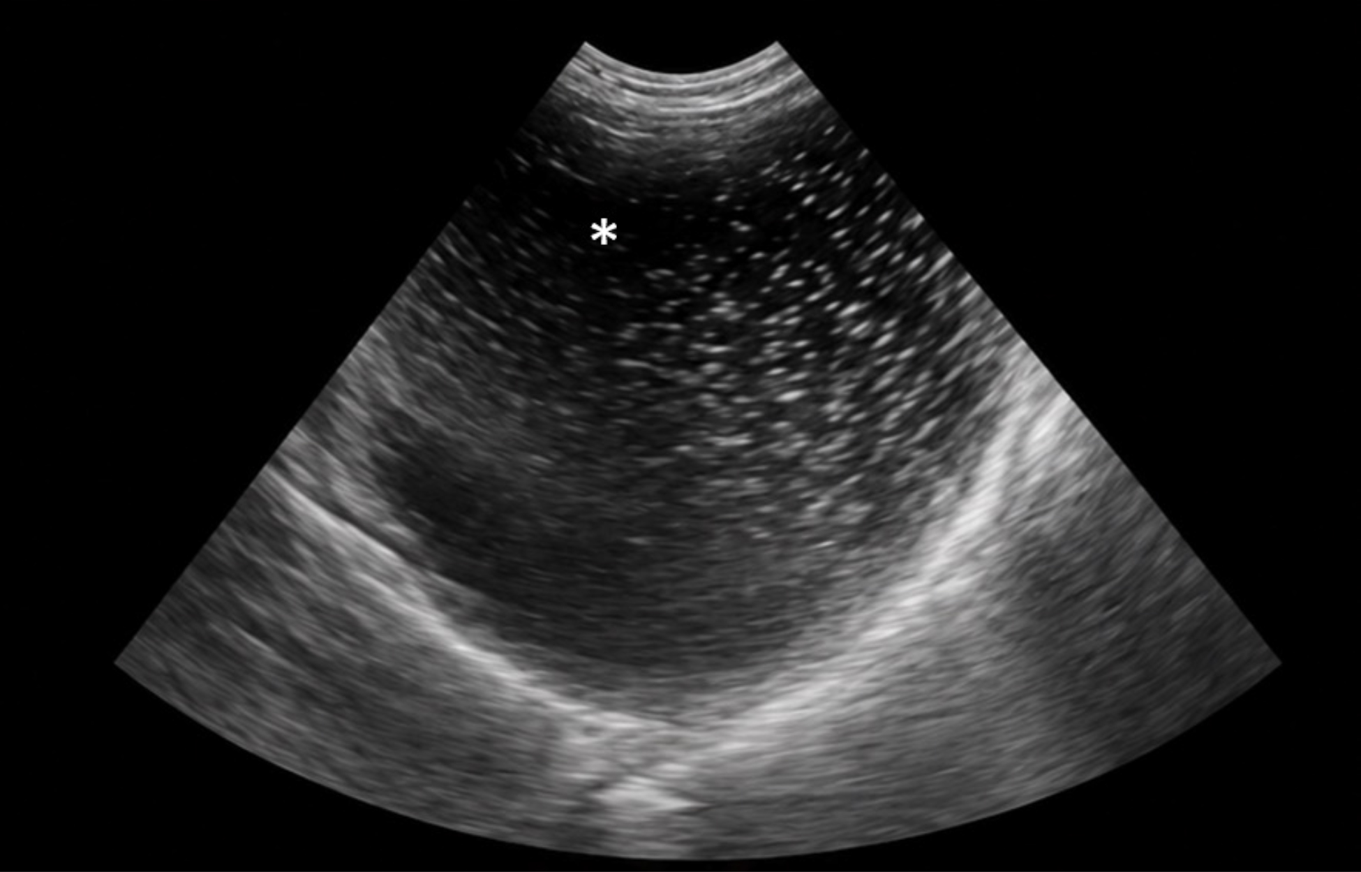 Ecografía abdominal <i>point-of-care</i> (POCUS) que evidencia una marcada distensión gástrica con abundante contenido intraluminal (*) y disminución de la motilidad, compatible con estasis gástrico. Este hallazgo apoya el empleo de procinéticos, antieméticos y descompresión mediante sondaje nasogástrico para reducir el riesgo de neumonía por aspiración y permitir el establecimiento temprano de nutrición enteral, estrategia asociada a una reducción de la estancia hospitalaria en pacientes con peritonitis séptica.[1,2,5]