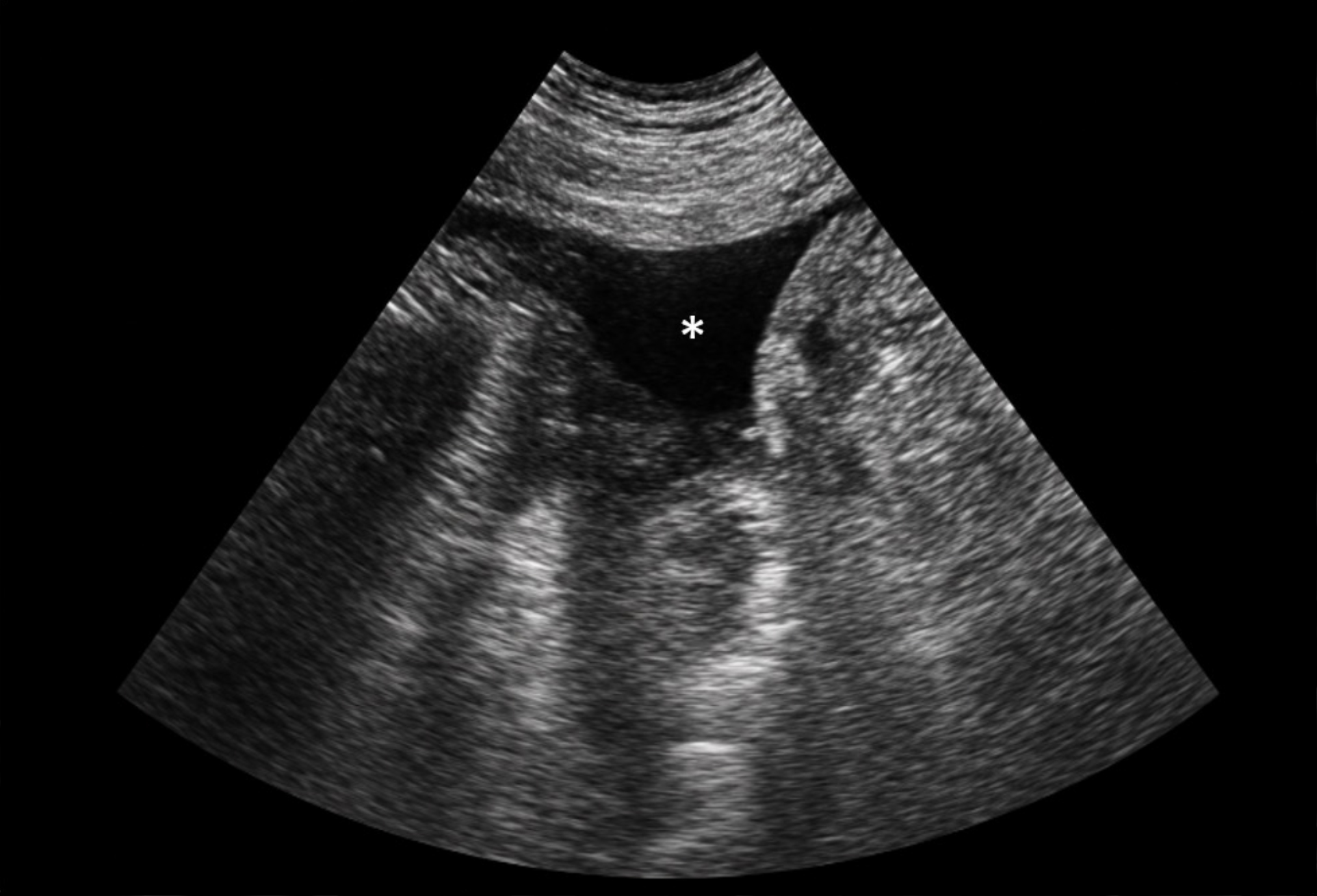 Ecografía abdominal <i>point-of-care</i> (POCUS) que evidencia la presencia de líquido libre (*) en la ventana umbilical, localizada en la región ventral gravitacionalmente dependiente del abdomen. La identificación ecográfica de efusión peritoneal debe complementarse con una abdominocentesis ecoguiada para la obtención de muestras destinadas a análisis citológico, bioquímico y microbiológico, constituyendo el siguiente paso diagnóstico ante la sospecha de peritonitis séptica.[5]