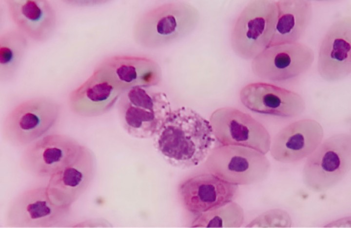 Frotis sanguíneo de<i> Trachemys scripta</i> con presencia de heterófilos tóxicos. Tinción diff-quick 100 x.