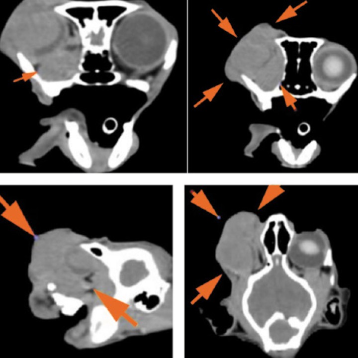 Imágenes tomográficas (transversal, sagital y coronal) donde se observa la masa de 3,3 × 3,7 × 5 cm (flechas) centrada en el globo ocular derecho, con atenuación de partes blandas y escasa captación periférica de contraste, que ocupa toda la órbita incluyendo el espacio retrobulbar, desplazando estructuras vasculares y con posible invasión del nervio óptico. Se extiende hacia el exterior sin provocar lesiones óseas en las estructuras adyacentes. Imagen cedida por el Hospital Bluecare.