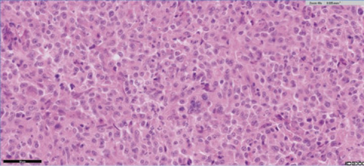 Imagen histológica donde se observa una proliferación celular con citoplasma eosinófilo fibrilar, núcleos ovalados con cromatina granular y nucléolo prominente. Hay marcada anisocitosis y anisocariosis, presencia de células multinucleadas y cariomegálicas, actividad mitótica moderada (3 mitosis en 2,37 mm²) y focos multifocales de necrosis con restos celulares. H&amp;E 400x. Imagen cedida por laboratorio Vetlab.