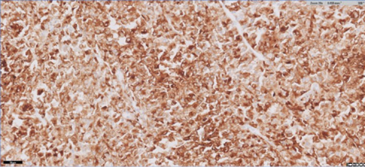 Imagen marcador CD204. Las células atípicas muestran un marcaje prominente de su membrana citoplásmica y citoplasma con este anticuerpo. Más del 90 % de las células atípicas en sección son positivas. H&amp;E 400x. Imagen cedida por laboratorio Vetlab.