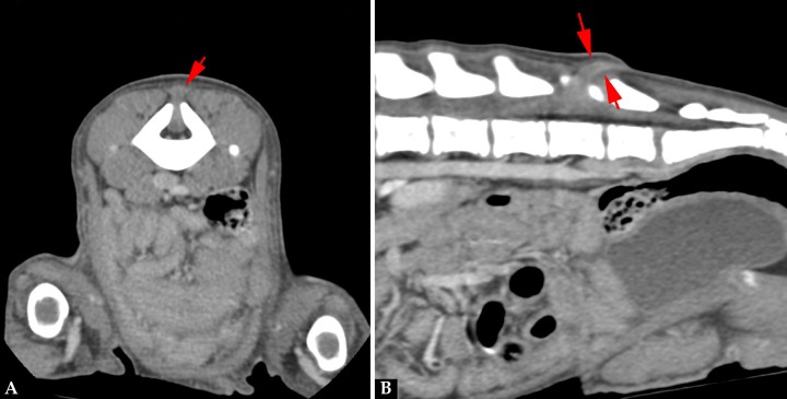 Imágenes de TC en ventana de tejidos blandos postcontraste. (A) Plano transversal. Defecto óseo vertebral con paso de tejido del canal vertebral, con atenuación tejido blando y realce periférico, hasta el tejido blando dorsal a L6-7 (flecha roja). (B) Reconstrucción en plano sagital.