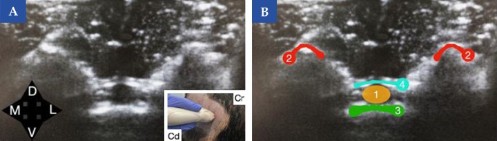 <b>Referencias ecográficas del espacio lumbosacro en el perro (vista transversal)</b>. (<b>A</b>) Imagen ecográfica encorte transversal obtenida con sonda lineal a nivel del espacio lumbosacro en un perro. En la imagen inferior derecha se muestra la posición de la sonda ecográfica en el animal (Cr, craneal y Cd, caudal). (<b>B</b>) Esquema de identificación de las principales referencias anatómicas: crestas ilíacas (2), suelo del canal vertebral (3) y ligamento amarillo (4). El sitio de inyección se localiza en el canal vertebral (1), guiado por estas estructuras de referencia. <b>¿Para qué usar esta técnica?</b>: Cirugía del tercio posterior y abdomen principalmente. Tratamiento de dolor crónico lumbosacro