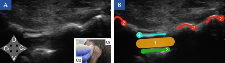 <b>Referencias ecográficas del espacio lumbosacro en el perro (vista longitudinal). </b>(<b>A</b>) Imagen ecográfica en corte longitudinal obtenida con sonda lineal a nivel del espacio lumbosacro en un perro. En la imagen inferior derecha se muestra la posición de la sonda ecográfica en el animal (Cr, craneal y Cd, caudal). (<b>B</b>) Esquema de identificación de las principales referencias anatómicas: apófisis espinosas (2) de vértebra L7 (izquierda de la imagen) y del sacro S1 y S2 (derecha de la imagen), suelo del canal vertebral (3) y ligamento amarillo (4). El sitio de inyección se localiza en el canal vertebral (1), delimitado por estas estructuras de referencia. <b>¿Para qué usar esta técnica?</b>: Cirugía del tercio posterior y abdomen principalmente. Tratamiento de dolor crónico lumbosacro.