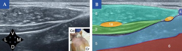 <b>Referencias ecográficas para el bloqueo en abordaje subcostal del plano del músculo transverso abdominal (TAP) y bloqueo de la vaina del recto abdominal en el perro.</b> (<b>A</b>) Imagen ecográfica obtenida con sonda lineal en posición transversal y ligeramente lateral a la línea alba, justo caudal al xifoides. En la imagen inferior derecha se muestra la posición de la sonda ecográfica en el animal (Cr, craneal y Cd, caudal). (<b>B</b>) Esquema de identificación de las principales estructuras anatómicas: músculo transverso del abdomen (2), músculo recto del abdomen (3), línea alba (4), grasa abdominal (5) y cavidad abdominal (6). El peritoneo se señala con una línea negra discontinua. Se muestran dos posibles sitios de inyección según la técnica empleada: 1a) el correspondiente al abordaje subcostal del bloqueo del plano del músculo transverso del abdomen (TAP), depositando el anestésico local entre las fascias de los músculos recto abdominal y transverso del abdomen en la parte ventral del abdomen para continuar entre las fascias del músculo oblicuo interno y transverso del abdomen una vez que vamos más laterales y el músculo recto del abdomen desaparece; 1b) el bloqueo de la vaina del músculo recto del abdomen, depositando el anestésico local entre el músculo recto abdominal y el peritoneo. <b>¿Para qué usar esta técnica?</b>: Bloqueo de la vaina del músculo recto abdominal: Cirugía de hernia umbilical. Bloqueo subcostal del músculo transverso abdominal: Analgesia somática para cirugía de abdomen craneal. Estos bloqueos deben realizarse de forma bilateral.