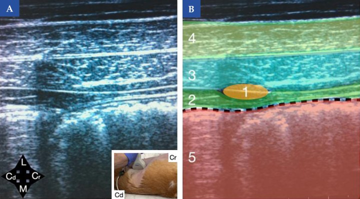 <b>Referencias ecográficas para el abordaje lateral del bloqueo del plano del músculo transverso abdominal (TAP) en el perro.</b> (<b>A</b>) Imagen ecográfica de la pared abdominal lateral obtenida con sonda lineal, colocada en orientación sagital a la columna vertebral. En la imagen inferior derecha se muestra la posición de la sonda ecográfica en el animal (Cr, craneal y Cd, caudal). (<b>B</b>) Esquema de identificación de las principales estructuras anatómicas: músculo transverso del abdomen (2), músculo oblicuo interno (3), músculo oblicuo externo (4), cavidad abdominal (5) y peritoneo señalado con línea negra discontinua. El sitio de inyección para el bloqueo del plano del músculo transverso del abdomen (TAP) (1) se localiza entre las fascias de los músculos transverso del abdomen y oblicuo interno, donde se deposita el anestésico local.<b> ¿Para qué usar esta técnica?</b>: Bloqueo del plano del músculo transverso abdominal: Analgesia somática para cirugía abdominal y mastectomía. Este bloqueo debe realizarse de forma bilateral.