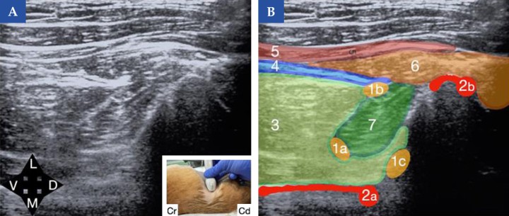 <b>Referencias ecográficas para el bloqueo del cuadrado lumbar (QLB) en el perro. </b>(<b>A</b>) Imagen ecográfica obtenida al colocar una sonda lineal caudal a la última costilla, en orientación transversal a la columna y justo ventral a las apófisis transversas. En la imagen inferior derecha se muestra la posición de la sonda ecográfica en el animal (Cr, craneal y Cd, caudal). (<b>B</b>) Esquema de identificación de las principales referencias anatómicas: estructuras óseas (en rojo) correspondientes a la apófisis transversa (derecha y superior a la imagen, 2b) y al cuerpo vertebral (izquierda e inferior de la imagen, 2a), músculo cuadrado lumbar (verde oscuro), músculo psoas mayor (verde claro) (3), músculo transverso del abdomen (4) aproximándose al músculo cuadrado lumbar (7), músculo oblicuo interno (5) separándose del transverso abdominal, y grasa (6). Se ilustran tres posibles sitios de inyección según el abordaje deseado: (1a) abordaje transmuscular, depositando el anestésico local entre las fascias del cuadrado lumbar y psoas mayor; (1b) abordaje lateral, depositando el anestésico entre el músculo transverso del abdomen y el cuadrado lumbar; y (1c) abordaje dorsal, con depósito del anestésico local adyacente al cuerpo vertebral, en relación con el psoas mayor. <b>¿Para qué usar esta técnica?</b>: Analgesia somática y visceral para cirugía abdominal. Este bloqueo debe realizarse de forma bilateral.