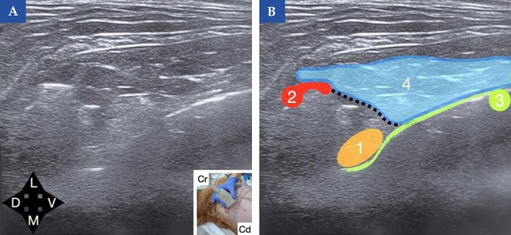 <b>Referencias ecográficas para el bloqueo paravertebral torácico en el perro.</b> (<b>A</b>) Imagen ecográfica obtenida al colocar una sonda lineal sobre la región dorsal del espacio intercostal. Esta técnica puede realizarse a nivel de T5-T6 para analgesia torácica o de T10-T11 para analgesia del abdomen craneal. En la imagen inferior derecha se muestra laposición de la sonda ecográfica en el animal (Cr, craneal y Cd, caudal). (<b>B</b>) Esquema de identificación de las principales referencias anatómicas: apófisis transversa vertebral (2), pleura (3) y musculatura dorsal (4). El espacio paravertebral está delimitado dorsalmente por el ligamento costotransverso (línea discontinua), ventrolateralmente por la pleura ymedialmente por la vértebra. El sitio de inyección se localiza en este espacio paravertebral (1); la correcta administración del anestésico local se confirma por el desplazamiento ventral de la pleura durante la inyección. <b>¿Para qué usar esta técnica?</b>: Analgesia somática y visceral para cirugía torácica o abdominal (según el punto de inyección). Este bloqueo debe realizarse de forma bilateral para cirugía abdominal y frecuentemente de forma unilateral para cirugía torácica.