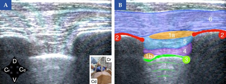 <b>Referencias ecográficas para el bloqueo del serrato y el bloqueo intercostal en el perro. </b>(<b>A</b>) Imagen ecográfica obtenida con una sonda lineal colocada sobre la pared costal a nivel de las costillas 5–6, en orientación paralela a la columna vertebral. En la imagen inferior derecha se muestra la posición de la sonda ecográfica en el animal (Cr, craneal y Cd, caudal). (<b>B</b>) Esquema de identificación de las principales estructuras anatómicas: costillas (2), pleura (3), líneas A pulmonares (7), músculo intercostal interno (4), músculo intercostal externo (5) y músculo serrato ventral (6). Se muestran dos posibles sitios de inyección según la técnica empleada: (1a) bloqueo del serrato, depositando el anestésico local entre las fascias del músculo serrato ventral y el músculo intercostal externo; y (1b) bloqueo intercostal, administrando el anestésico local en la región caudal de la costilla, profundo al músculo intercostal interno, con confirmación de la correcta distribución por el desplazamiento ventral de la pleura durante la inyección.<b> ¿Para qué usar esta técnica?</b>: Ambas técnicas: Analgesia somática para cirugía torácica.