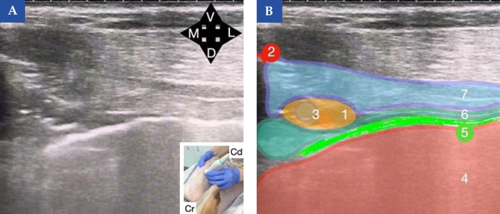 <b>Referencias ecográficas para el bloqueo del plano del músculo transverso torácico en el perro. </b>(<b>A</b>) Imagen ecográfica obtenida al colocar una sonda lineal en el espacio intercostal entre la 4.ª y 5.ª costilla, con el borde de la sonda apoyado ligeramente sobre el esternón. En la imagen inferior derecha se muestra la posición de la sonda ecográfica en el animal (Cr, craneal y Cd, caudal). (<b>B</b>) Esquema de identificación de las principales referencias anatómicas: esternón (2), arteria y vena torácicas internas (3), cavidad torácica (4), pleura (5), músculo transverso torácico (6) y músculo intercostal interno (7). El sitio de inyección (1) se localiza alrededor de los vasos torácicos internos, en el plano fascial entre los músculos transverso torácico e intercostal interno, guiado por estas estructuras de referencia. <b>¿Para qué usar esta técnica?</b>: Analgesia somática para esternotomía. Este bloqueo debe realizarse de forma bilateral.