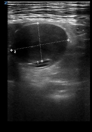 Imagen ecográfica de la lesión duodenal.