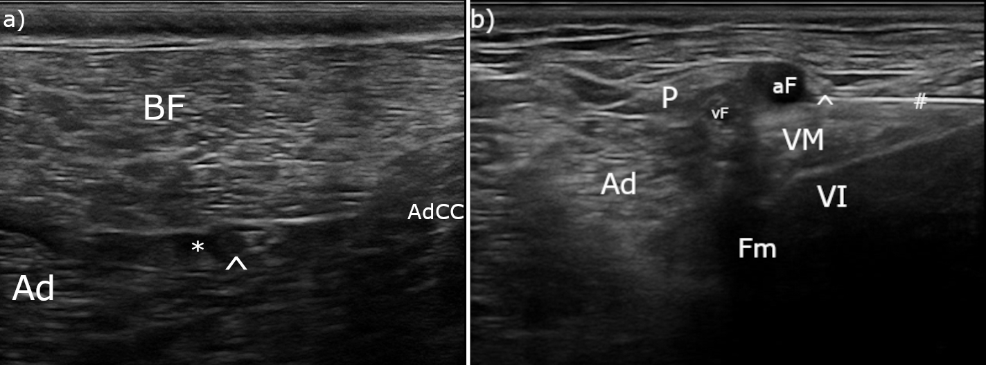 (A) Imagen ecográfica del bloqueo del nervio ciático, cabeza de flecha (^): nervio ciático, asterisco (*): anestésico local depositado en la fascia intermuscular; BF: músculo bíceps femoral, Ad: músculo aductor, AdCC: músculo aductor crural caudal. (B) Imagen ecográfica del bloqueo del nervio safeno, cabeza de flecha (^): nervio safeno, almohadilla (#): aguja sonovisible, aF: arteria femoral, vF: vena femoral, P: músculo pectíneo, Ad: músculo aductor, VM: músculo vasto medial, VI: músculo vasto intermedio, Fm: fémur.