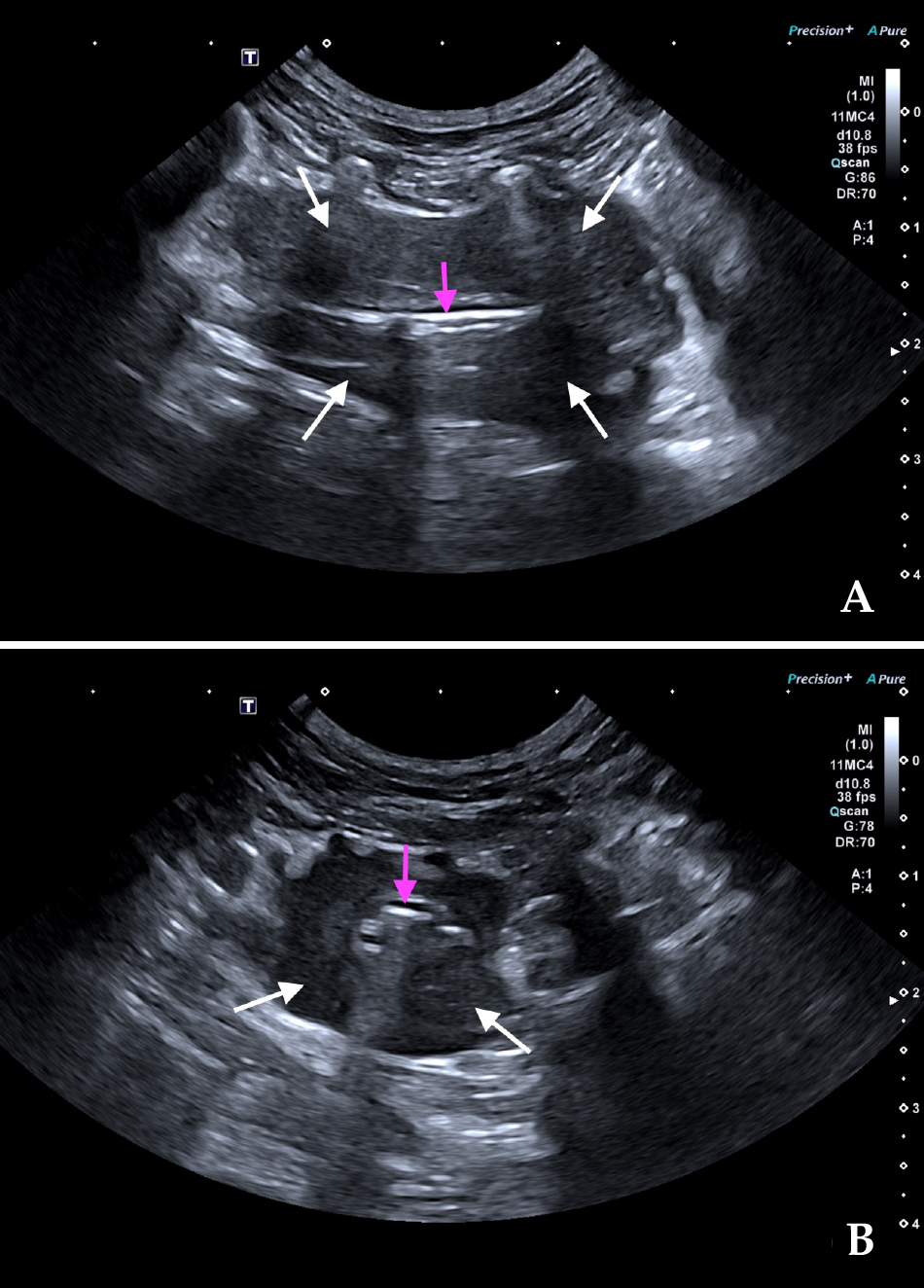 Imágenes ecográficas en cortes longitudinal (A) y transversal (B) de la masa traqueal obtenidas con abordaje intercostal. Se observa una lesión tipo masa concéntrica, de bordes ligeramente irregulares y bien definidos, hipoecoica y homogénea (flechas blancas) rodeando la luz traqueal (flechas rosas).