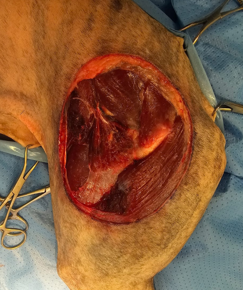 <b>Posicionamiento del paciente</b>. El paciente se coloca en decúbito lateral, con la extremidad afectada en posición superior. En defectos abdominales, el paciente se posiciona en decúbito dorsal, incluyendo la región proximal de la(s) extremidad(es) en el campo quirúrgico.